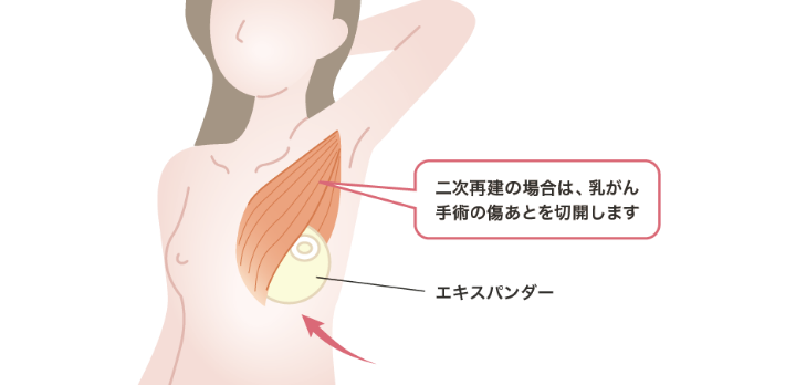 インプラント挿入